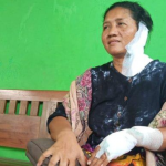 Dasih Korban Pelemparan Air Keras oleh Orang Tak Dikenal